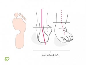 knick-senkfuss-850x638